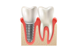 Implante Dentário em Bragança Paulista | Dra. Vanessa Kikuchi